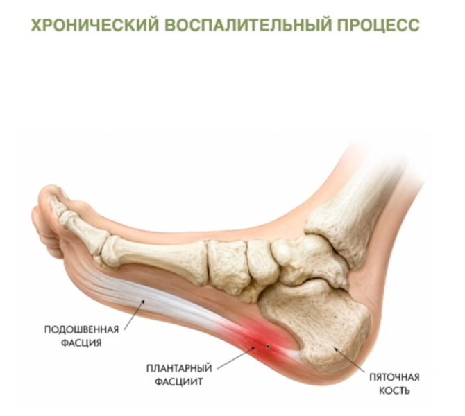 Ищу лечение фасциита на левой ноге